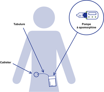 Pompe à Apomorphine : port de la pompe