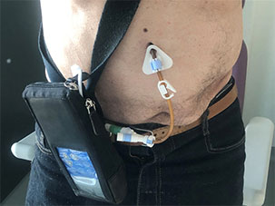 Pompe à Levodopa : Photo de la gastrostomie